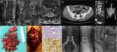 Surgical management and outcomes of spinal metastasis of malignant adrenal tumor: A retrospective study of six cases and literature review